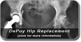 DePuy hip replacement
